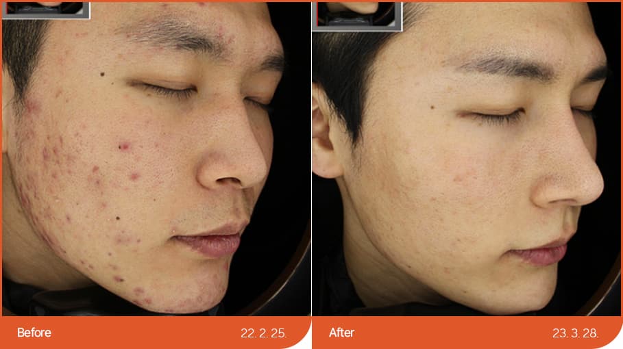 痤疮/疤痕治疗