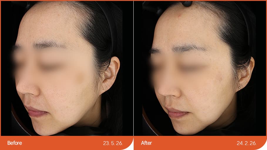 色素性疾病治疗