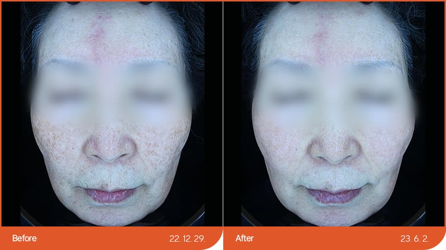 色素性疾病治疗