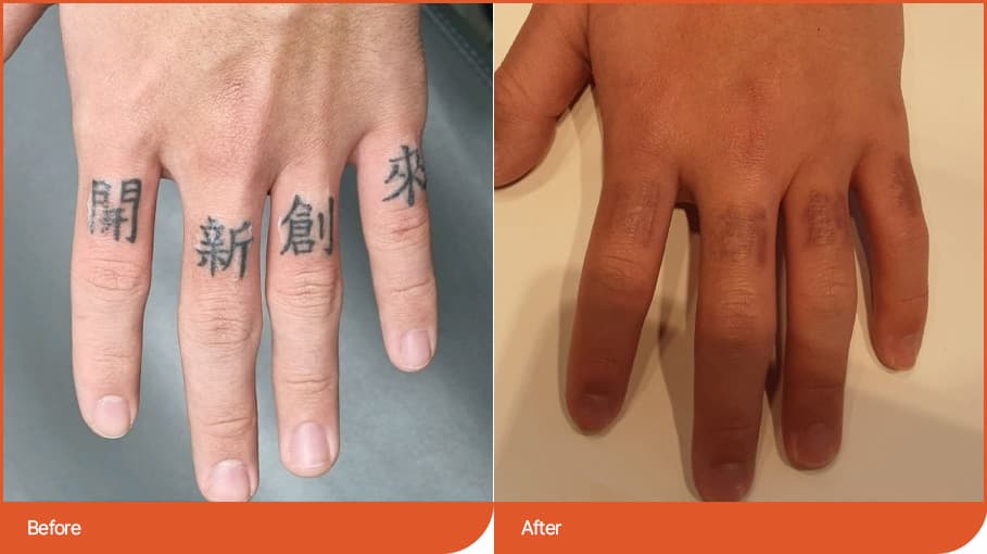 纹身去除