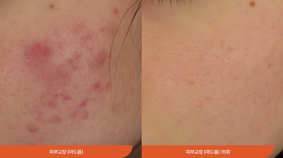 敏感性皮肤治疗